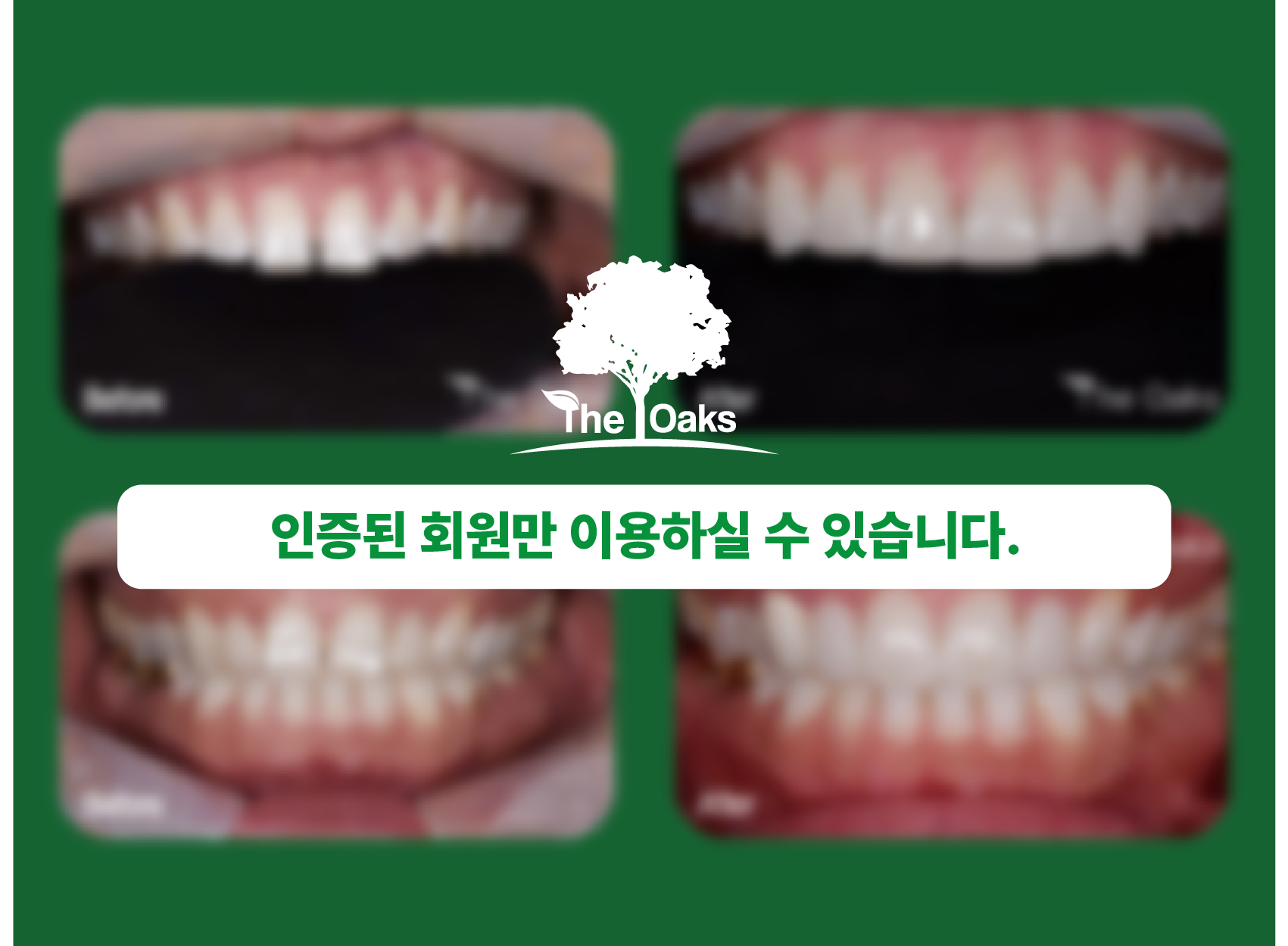 치아교정 전후사진
